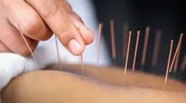Séance d'acupuncture avec de fines aiguilles insérées dans le dos